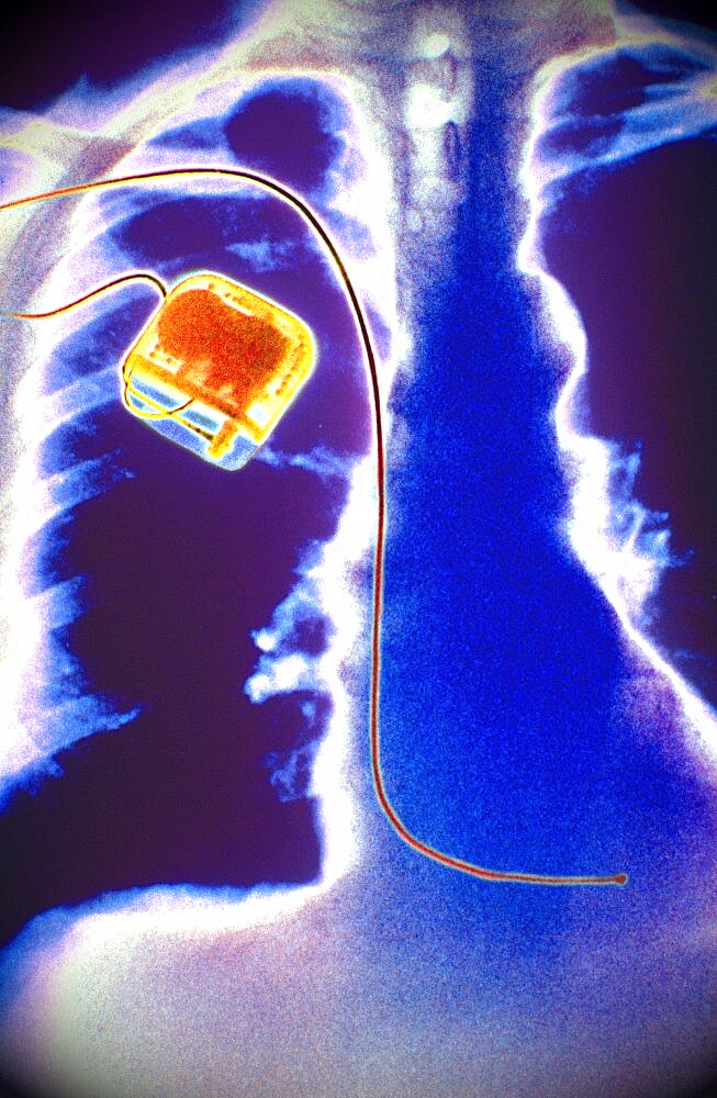 X-Ray Showing Pacemaker