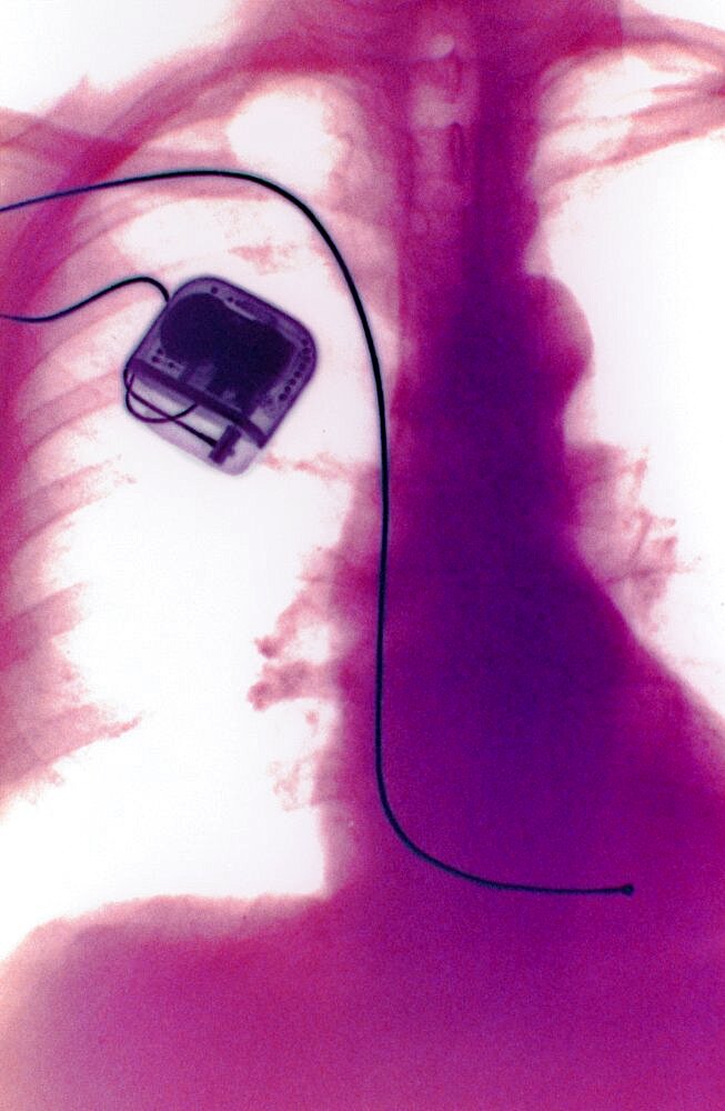 X-Ray Showing Pacemaker