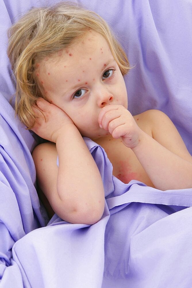 Child with Chickenpox