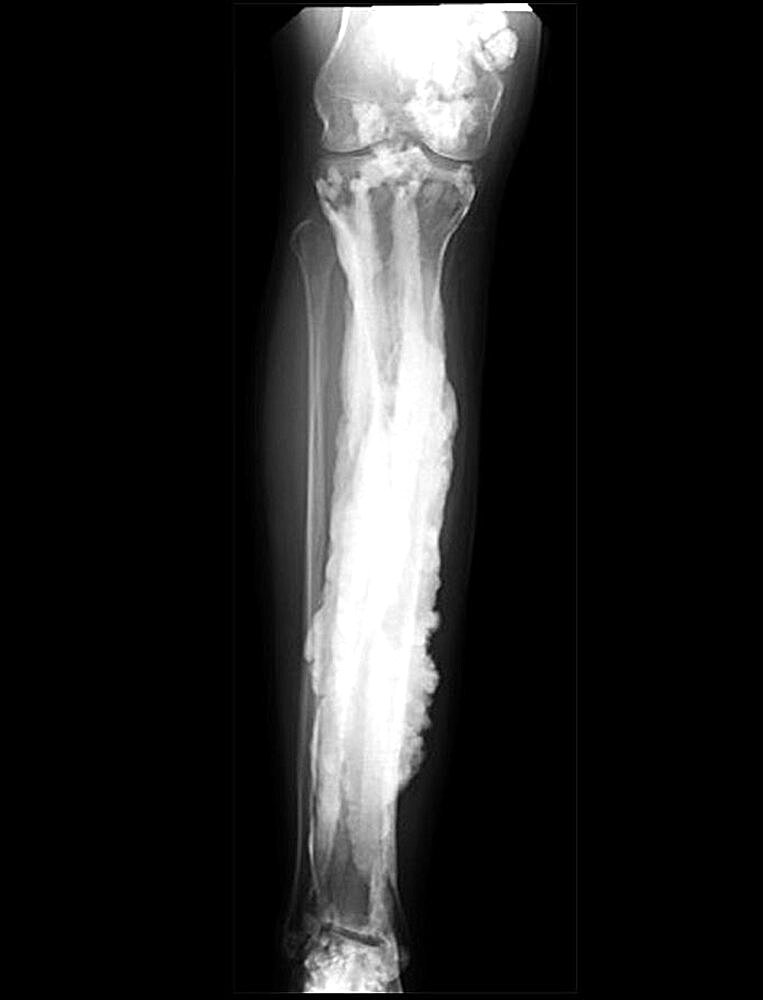 Melorheostosis Bone Disease, X-Ray