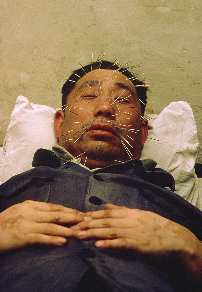 Man with many acupuncture needles in face, Beijing, China, Asia