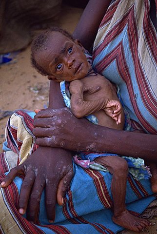 Emaciated baby in refugee camp in 1992, Mogadishu, Somalia, Africa