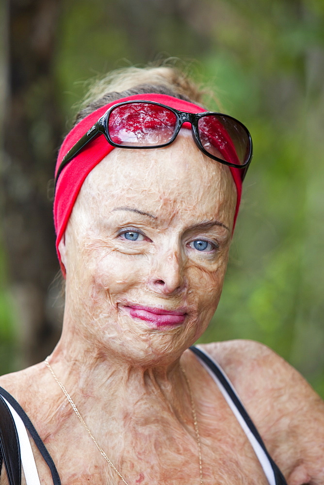 A lady who was horribly burned in a house fire and who now work for the Peter Hughes Burn Foundation providing counselling and support for the victims of bush fires, Australia, Pacific