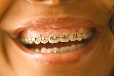 Close up of African woman with orthodontic braces