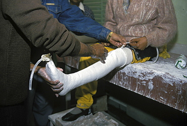 Healthcare, india. Jaipur. Local technicians fitting an artificial jaipur foot