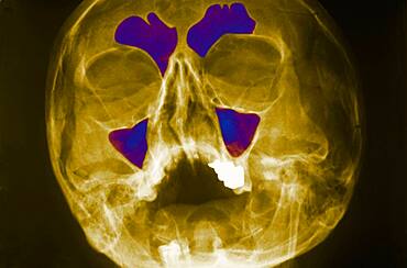 Sinus, x-ray