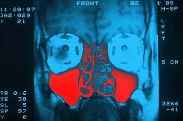 Sinus, mri