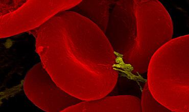 Highly enlarged scanning electron micrograph (SEM) depicted a closer look at the details exhibited by of number of red blood cells found enmeshed in a fibrinous matrix