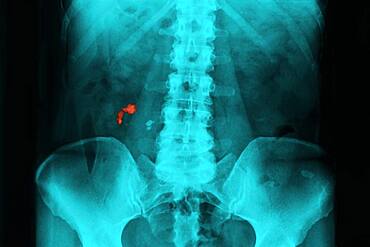 Renal lithiasis, x-ray