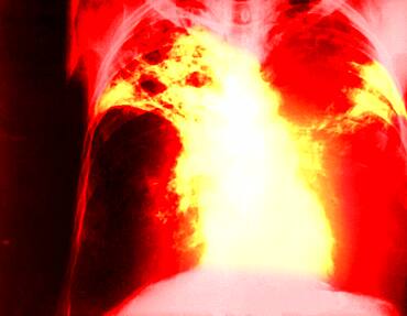 Pulmonary tuberculosis, x-ray