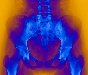 Pelvis, x-ray