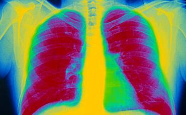 Lung, x-ray result