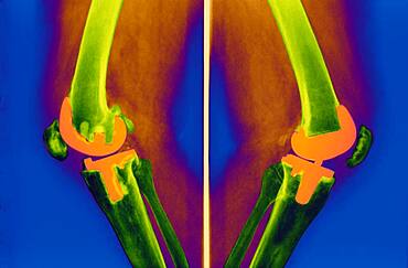 Knee prosthesis, x-ray