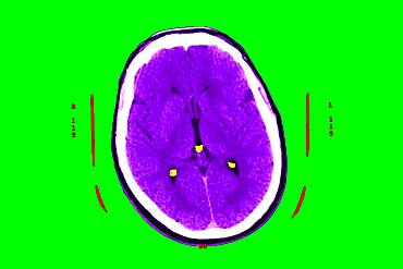 Hyperflash in the two nuclei and particularly the putamen, and the two thalamus.