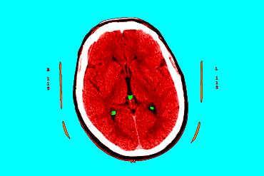 Hyperflash in the two nuclei and particularly the putamen, and the two thalamus.