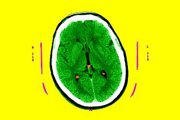 Hyperflash in the two nuclei and particularly the putamen, and the two thalamus.