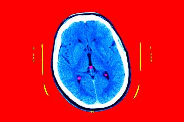 Hyperflash in the two nuclei and particularly the putamen, and the two thalamus.