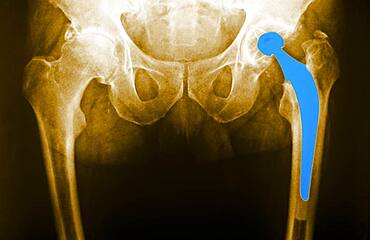 Hip prosthesis, x-ray