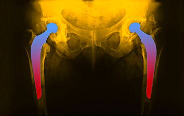 Hip prosthesis, x-ray