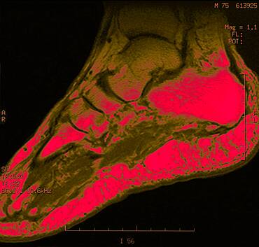 Foot, mri