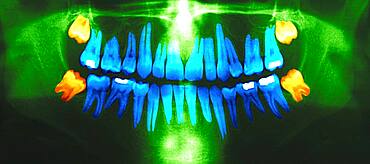 Dental panoramic x-ray. In orange, the wisdom teeth.