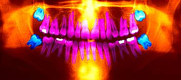 Dental panoramic x-ray. In blue, the wisdom teeth.