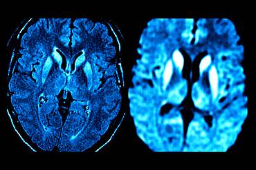 Bilateral lesions of the caudate heads, the putamens, and the internal posterior region of the two thalami (image on the right).