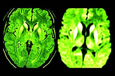 Bilateral lesions of the caudate heads, the putamens, and the internal posterior region of the two thalami (image on the right).