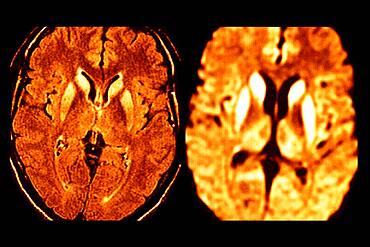 Affecting the two caudate nuclei in the head, the two putamens and the posterointernal part of the two thalamus (on the right document).