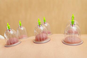 close up patient experiencing cupping therapy. High resolution photo