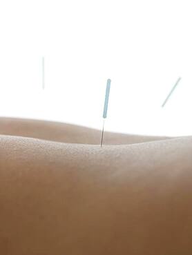 Close up of acupuncture needles in back of woman