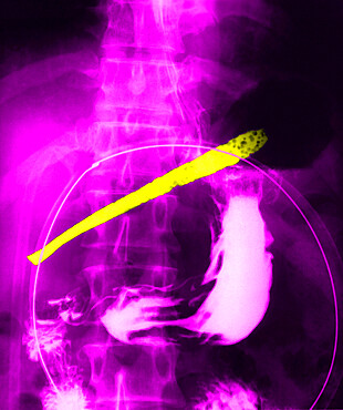 Patient having ingested a tineless fork. The stem of the fork, located in the stomach cavity, shows holes due to the corrosive action of the stomach's hydrochloric acid. The head of the fork has pierced the greater curvature