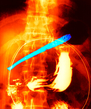 Patient having ingested a tineless fork. The stem of the fork, located in the stomach cavity, shows holes due to the corrosive action of the stomach's hydrochloric acid. The head of the fork has pierced the greater curvature