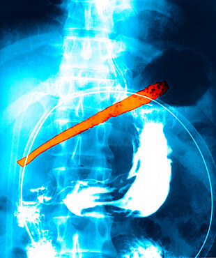 Patient having ingested a tineless fork. The stem of the fork, located in the stomach cavity, shows holes due to the corrosive action of the stomach's hydrochloric acid. The head of the fork has pierced the greater curvature