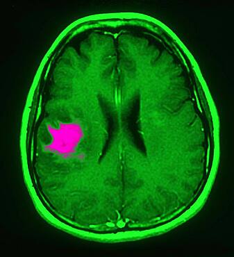 Nmr cerebral lymphoma