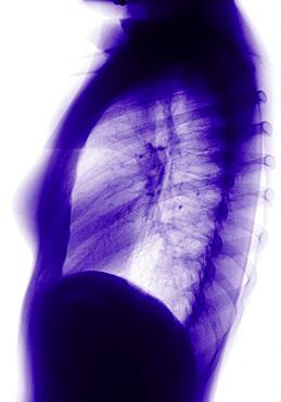 Lung, x-ray result