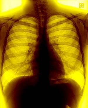 Lung, x-ray result