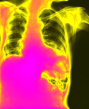 Diaphragmatic hernia. Following a trauma, the left diaphragm has burst. The upper area of the stomach and colon have passed through the wound into the thorax.