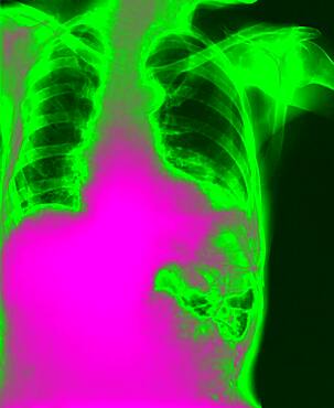 Diaphragmatic hernia. Following a trauma, the left diaphragm has burst. The upper area of the stomach and colon have passed through the wound into the thorax.