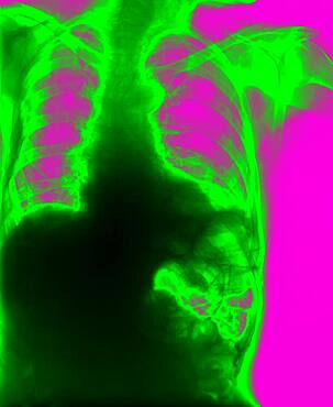 Diaphragmatic hernia. Following a trauma, the left diaphragm has burst. The upper area of the stomach and colon have passed through the wound into the thorax.