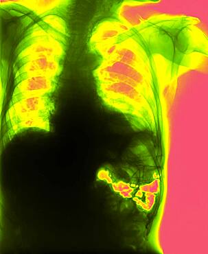 Diaphragmatic hernia. Following a trauma, the left diaphragm has burst. The upper area of the stomach and colon have passed through the wound into the thorax.