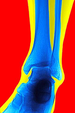 Ankle, x-ray