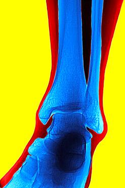 Ankle, x-ray