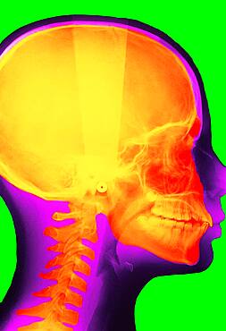 X-ray of the skull.