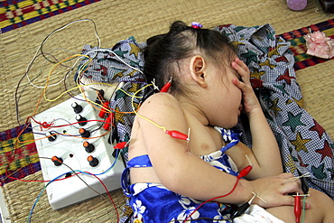 Vietnam child receiving acupuncture treatment at hospital in hanoi