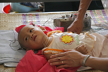 Vietnam child receiving acupuncture treatment at hospital in hanoi