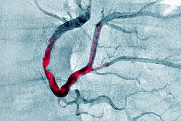 Myocardial infarction with a significant thrombus