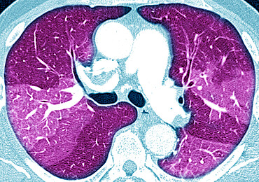 Pulmonary fibrosis (lesion of the lungs characterized by the presence of excess fibrous connective tissue), chest scanner