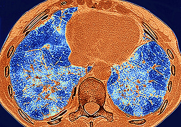 Pulmonary fibrosis (lesion of the lungs characterized by the presence of excess fibrous connective tissue), chest scanner