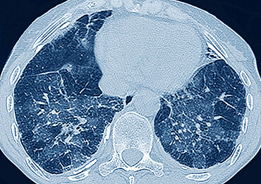 Pulmonary fibrosis (lesion of the lungs characterized by the presence of excess fibrous connective tissue), chest scanner